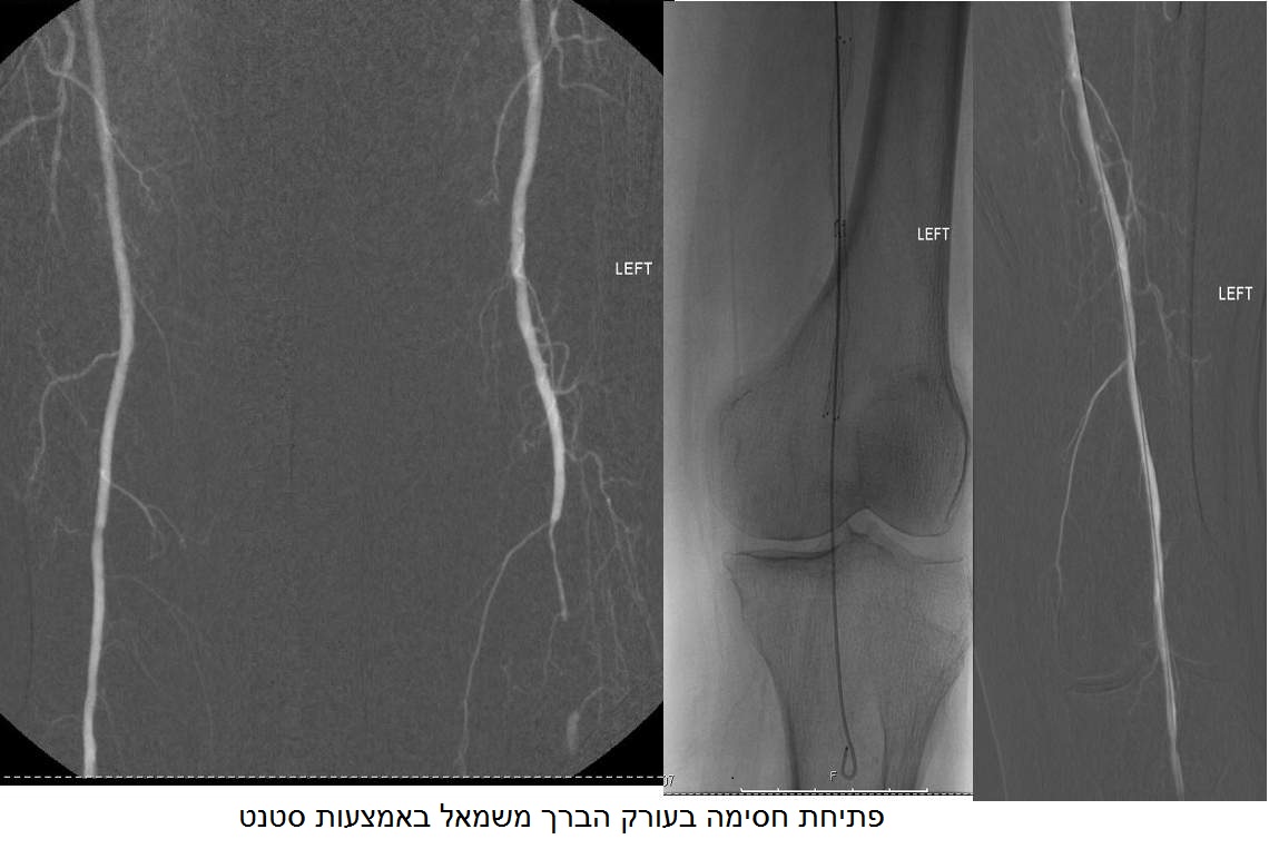 פתיחת חסימה בעורק הברך משמאל באמצעות סטנט