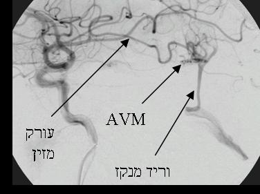 איור של הוריד המנקז והעורק המזין לצד האיי וי אמ