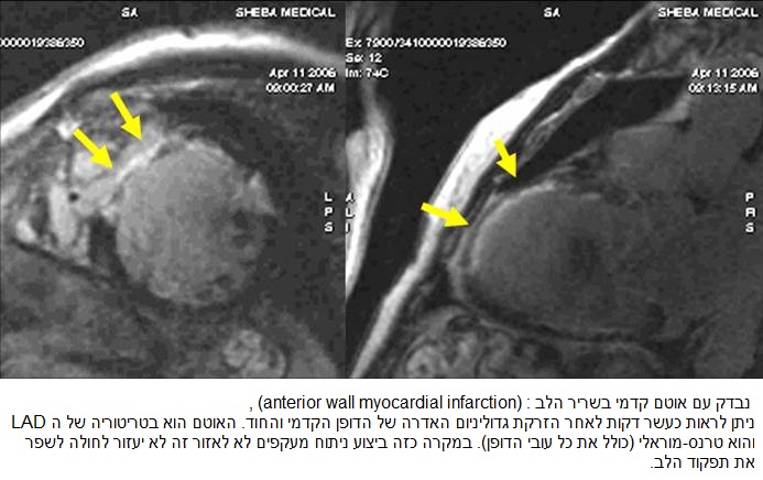  נבדק עם אוטם קדמי בשריר הלב , (anterior wall myocardial infarction) : ניתן לראות כעשר דקות לאחר הזרקת גדוליניום האדרה של הדופן הקדמי והחוד. האוטם הוא בטריטוריה של ה LAD והוא טרנס-מוראלי (כולל את כל עובי הדופן). במקרה כזה ביצוע ניתוח מעקפים לא לאזור זה לא יעזור לחולה לשפר את תפקוד הלב