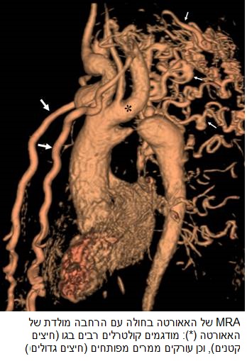 MRA של האאורטה בחולה עם הרחבה מולדת של האאורטה (*): מודגמים קולטרלים רבים בגו (חיצים קטנים), וכן עורקים ממרים מפותחים (חיצים גדולים)