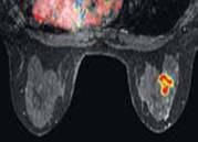  תמונת MRI לאחר עיבוד מחשב - CAD 