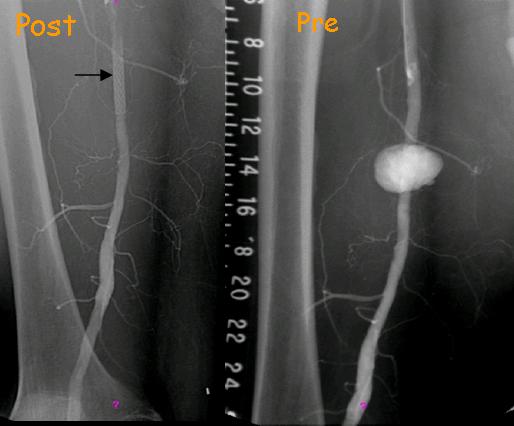 מפרצת של עורק הירך שטופלה עם סטנט גרפט בלבד 